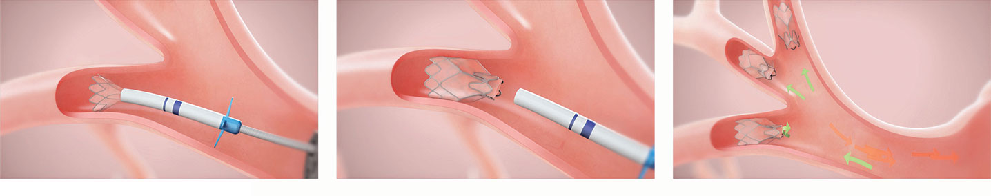 lung valve diagram